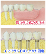 インプラント治療のメリット３｜歯の安定感