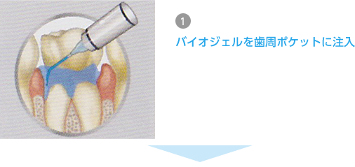1.バイオジェルを歯周ポケットに注入