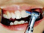 １.プラスチックのチップを使って歯と歯の間の汚れを落とします。