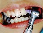 ２.歯肉を傷つけないように、三角ラバーコーンで歯と歯肉の境目の汚れを落とします。