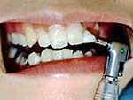 ３.歯の質を強くし輝きを増やすために、綺麗になった歯面にフッ素入りペーストを塗布し最終研磨して終了です。